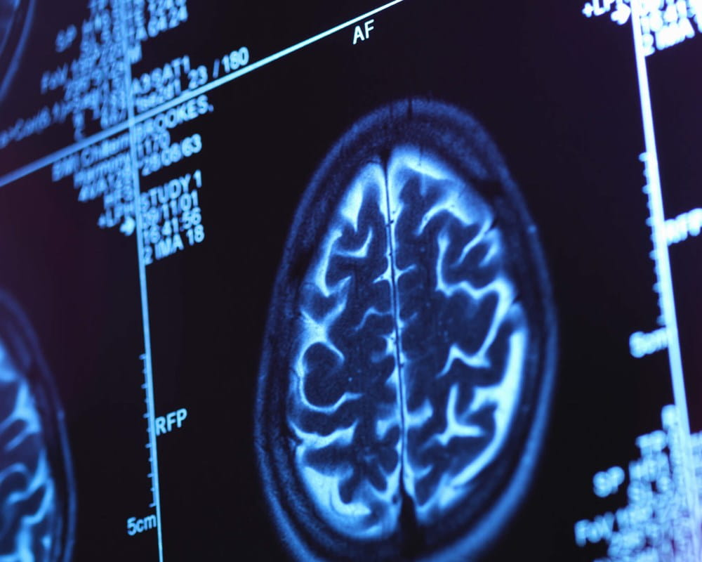 Brain scan