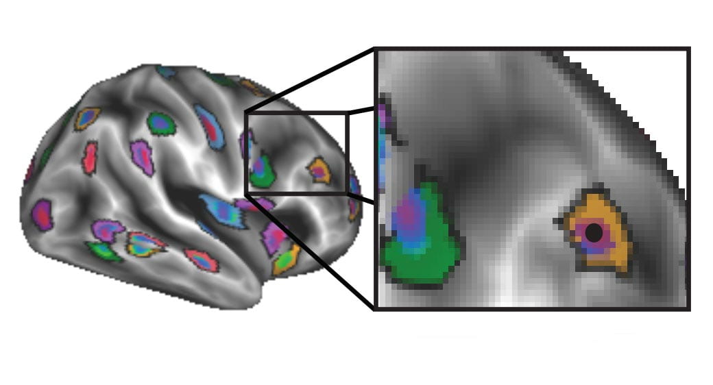 Illustration showing brain image after applying personalized mapping