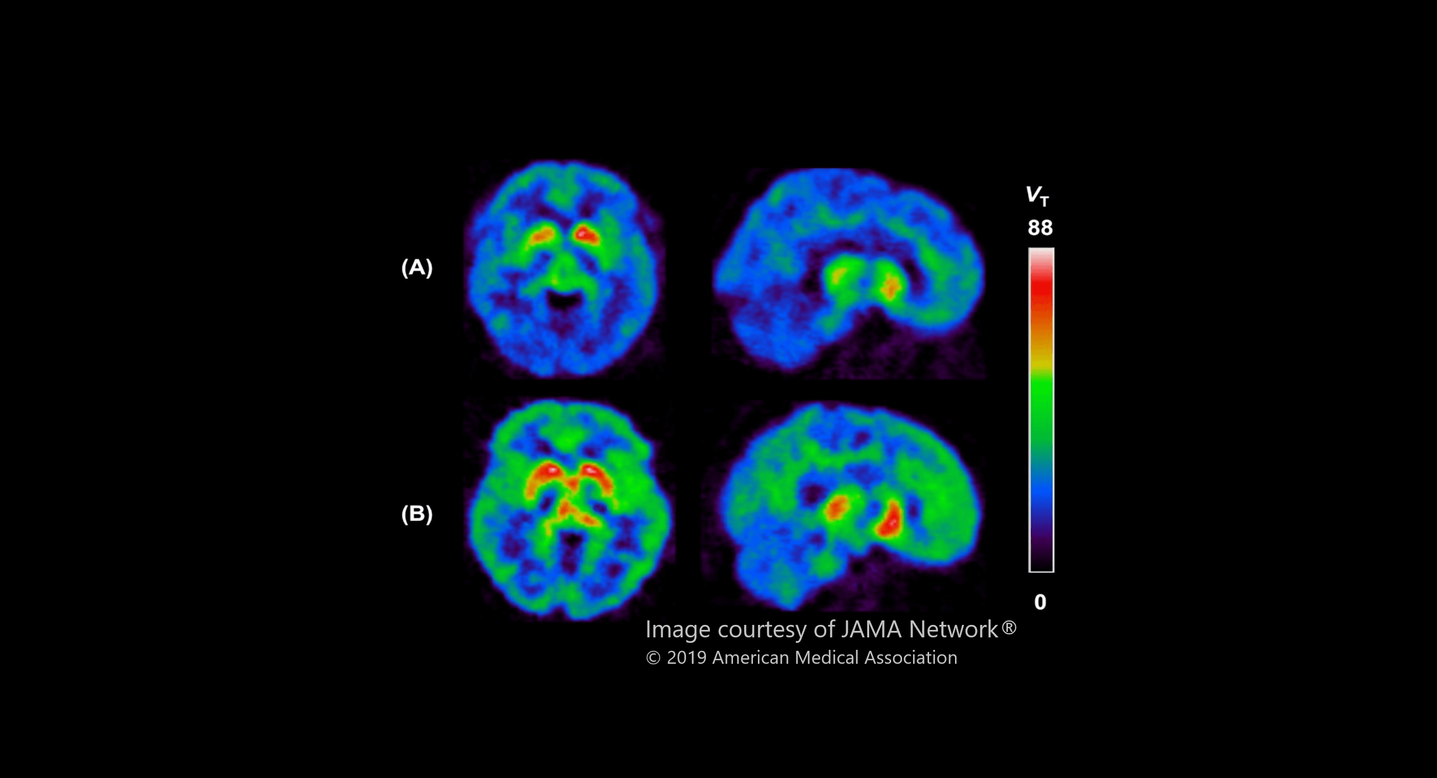 Brain images showing MAO-B levels in a depression study by CAMH's Dr. Jeffrey Meyer