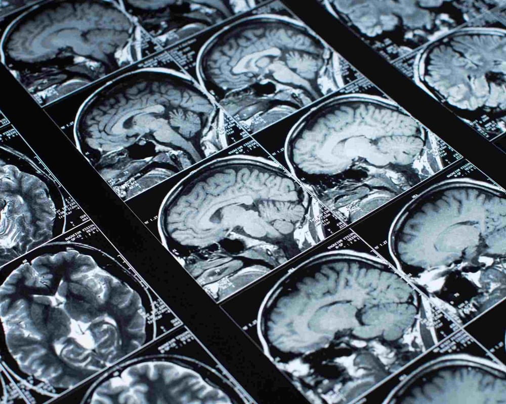 Brain Imaging Scans